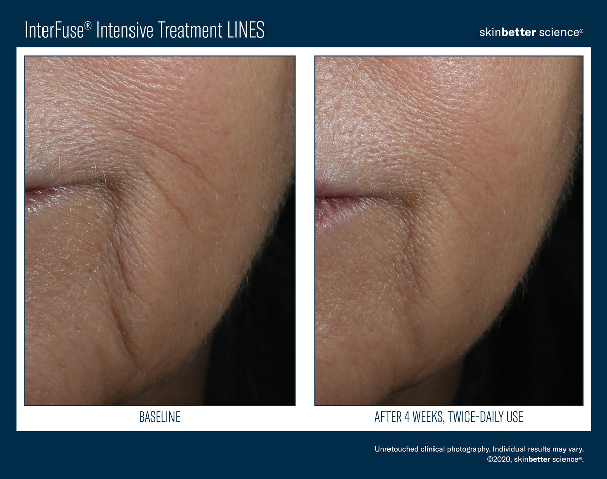InterFuse Intensive Treatment LINES 30 ml